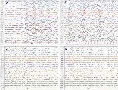 Infantile epileptic spasms syndrome as an initial presentation in infantile choroid plexus papilloma: A case report